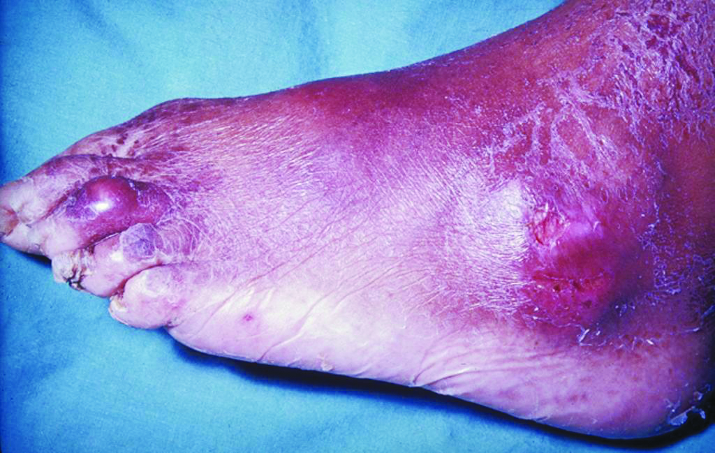 Gout - Complications - NHS Choices
